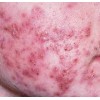 MỤN TRỨNG CÁ VÀ CÁCH CHĂM SÓC DA BỊ MỤN